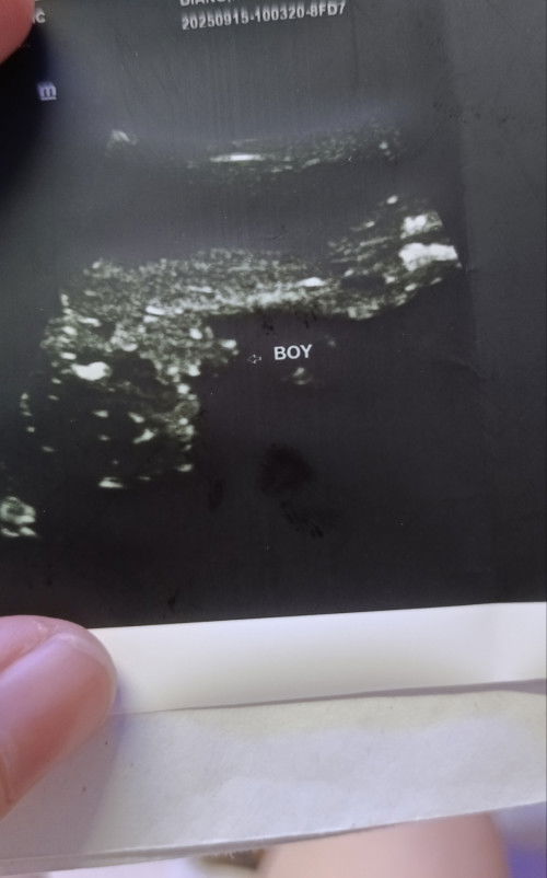 100% sure baby boy kaya po ito mga mii? Thank you po sa response, God bless you 😇😊