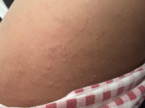 แบบนี้เรียกลมพิษไหมคะ  ท้อง39+3wค่ะ คันมาก