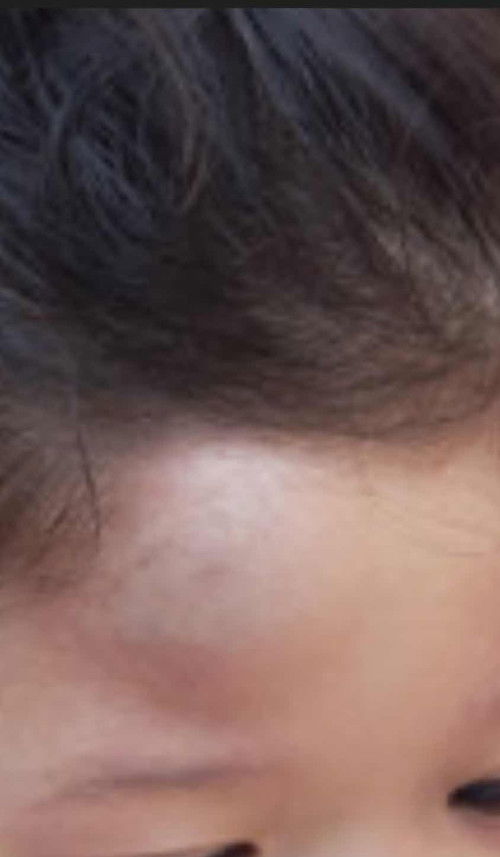 My toddler fell off the bed and hit his head.