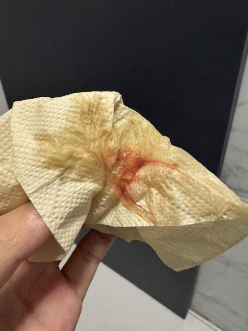 DISCHARGE CONCERN PO