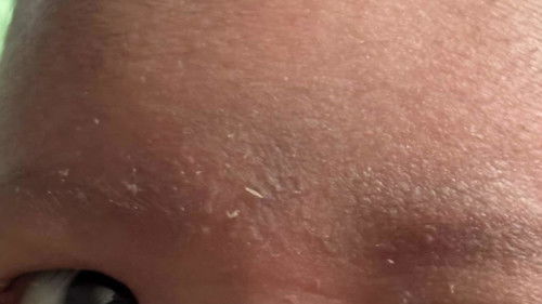 Ni cradle cap ke ibu?