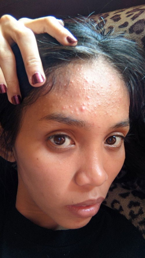 Jerawat dan bruntusan