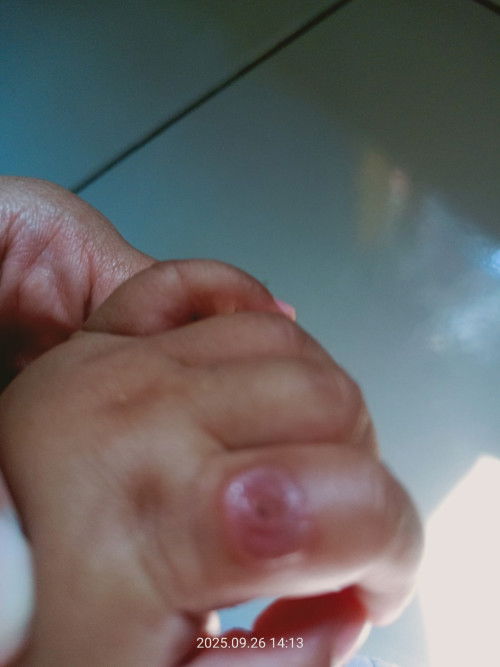 Tadinya bintik merahh trs meletus ehh jadinya kaya bolong gtuhh
