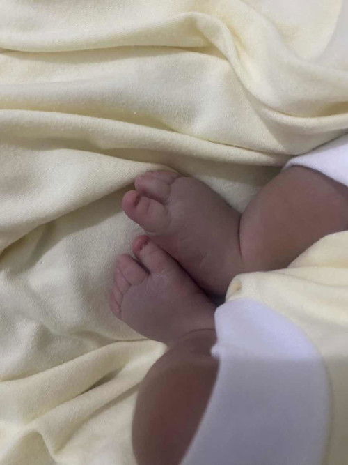 Baby new born lahir kakinya bengkak