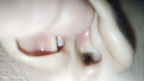 Kotoran dikuping bayi