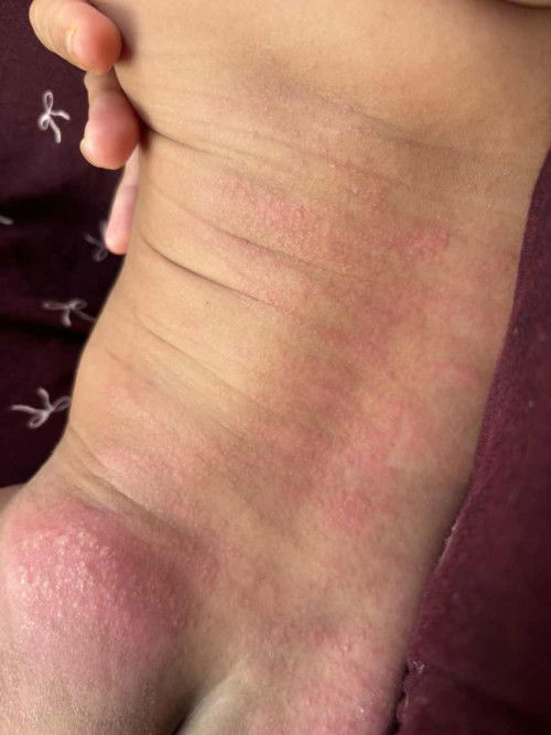 Ruam di pantat dan punggung