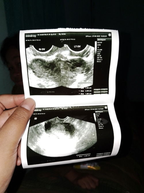 Hasil USG Transvaginal telat haid 17 hari hasil tespack pernah samar dan (-)