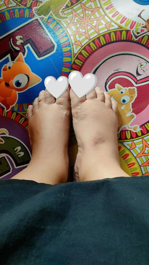 Kaki bengkak