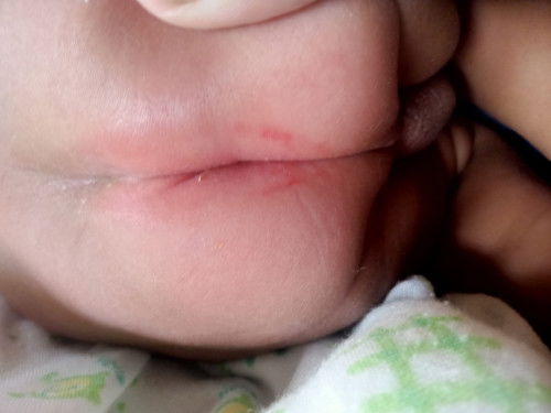 มีรอยแดง ตรงบริเวณก้น