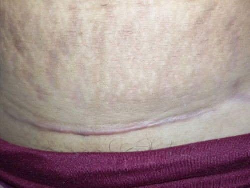 keloid atau bukan