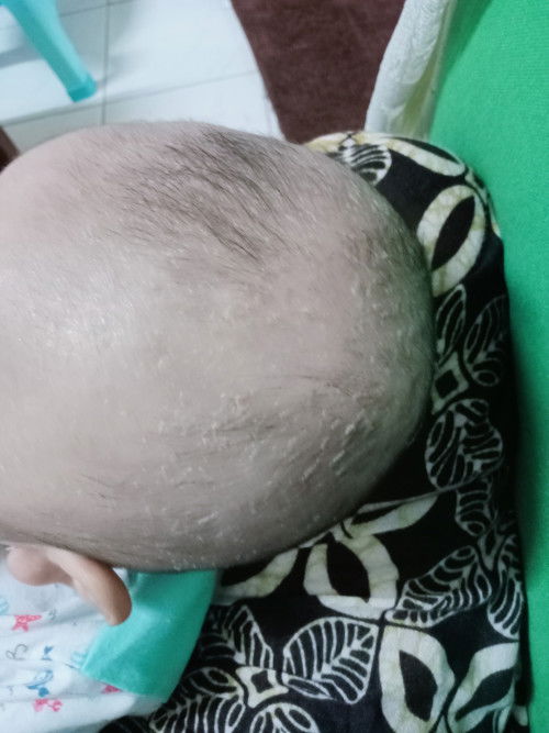Kulit kepala mengelupas