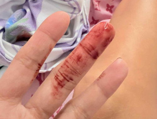 Bledding im pregnant