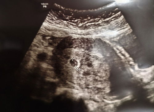 Kena ada 3 lingkaran di hasil USG