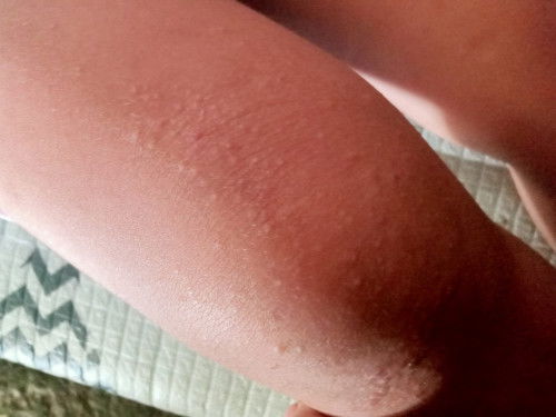 Hello mau tanya..adakah anak kamu pernah alamak bintik" di lutut begini...apa ubat ya..kasih hiang