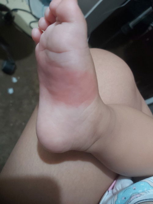 Ano po kaya ito paggsing po nin kninang umga meron n po pagtanggal k ng medyas ni baby po,