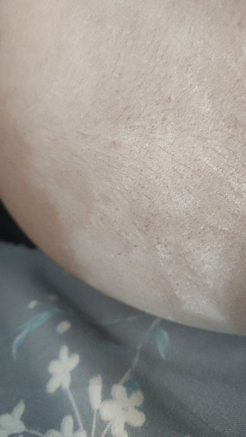 Trimester 2 (26 week) ngerasain nyeri dada bagian kiri + bintik merah gatel diperut