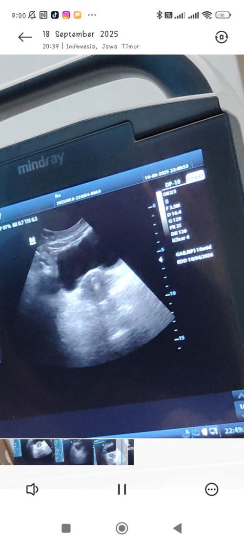 Kehamilan 8 minggu tidak merasakan tanda tanda kehamilan apakah wajar...??