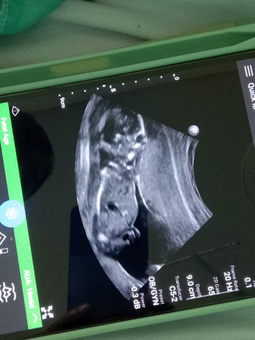 17วีคเเล้วยังไม่เห็นเพศเลยคะ