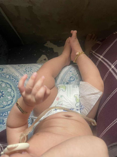 Club Foot baby