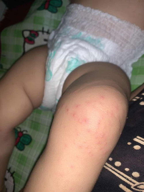 bayi bentol bentol merah