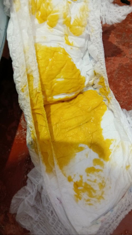 Bab bayi Usia 2 bulan apakah normal babnya sehari 1x kadang 2 hari g bab dan tkesturnya seperti ini#