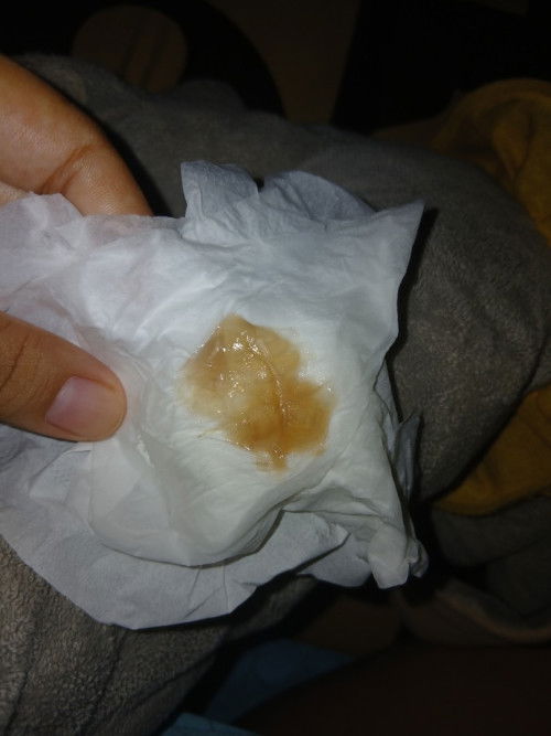 Kira² ini kenapa yaa,barusan pas pee keluar kayak gtu,tekstur kayak jelly