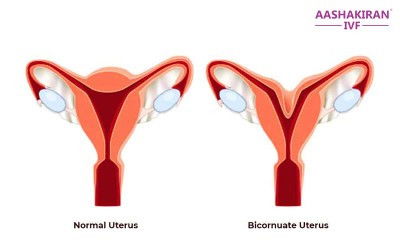 Bicornuate uterus (rahim berbentuk love)