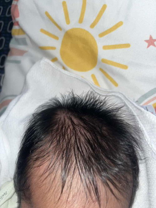 Malambot na bukol sa ulo
