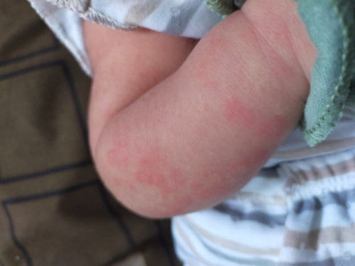 Kulit bayi 15 hari ruam dan beruntusan