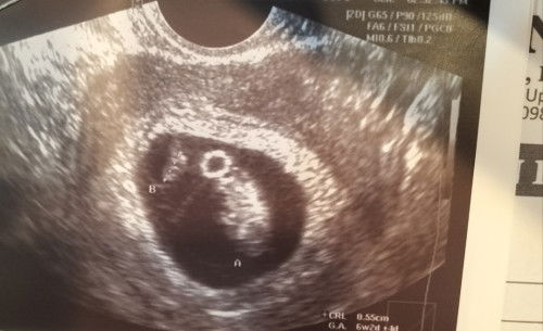 Anyone here who had monochorionic diamniotic twin?