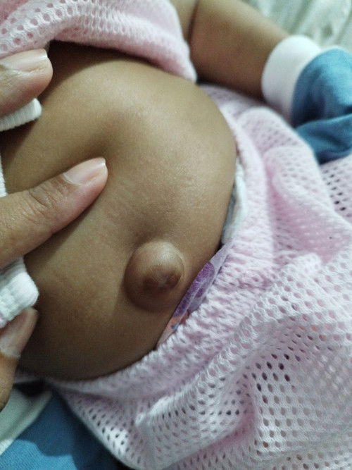 HERNIA PADA BABY GIRL