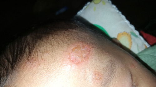 Bun anakku usia 3 bulan gatal membulat dan bernanah kira2 kenapa ya dan sharing obat nya