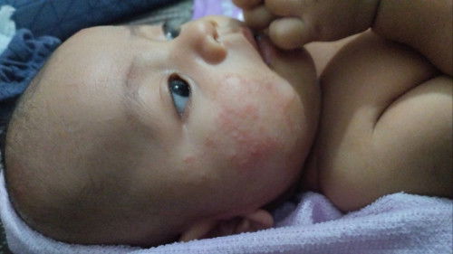Dermatitis