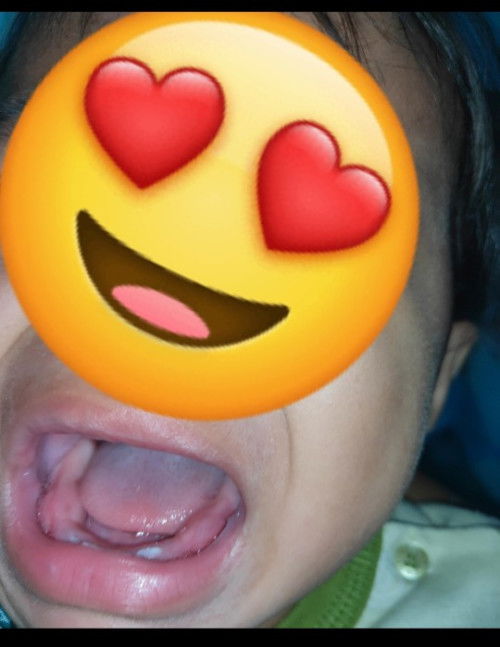 Gusi Bengkak anak 1tahun