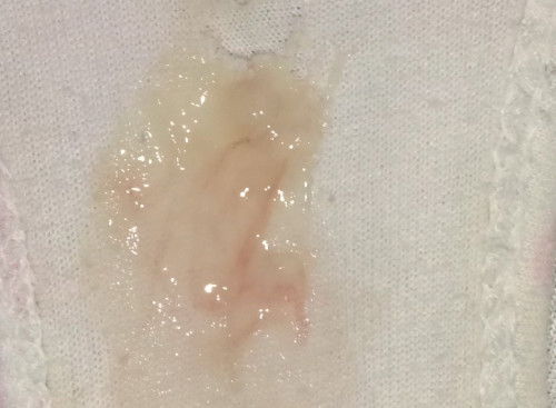 Mucus plug ba?