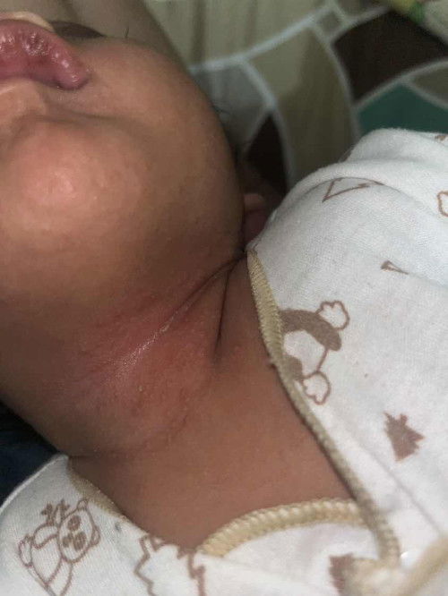 biang keringat ruam merah