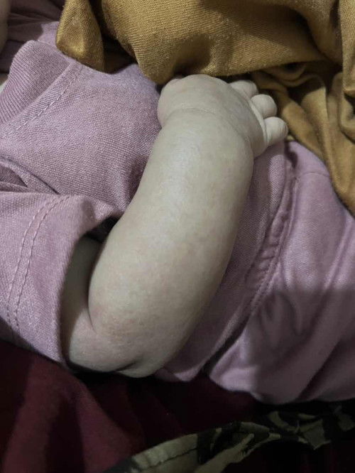 Bintik bintik merah pada kulit bayi