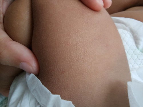 Ruam ke and berapa lama untuk hilang?