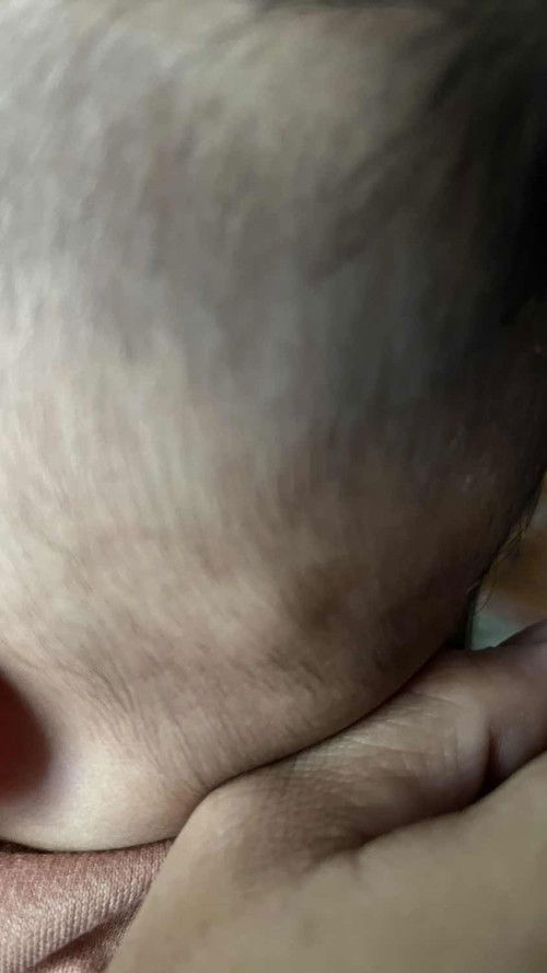 benjolan kecil di belakang telinga