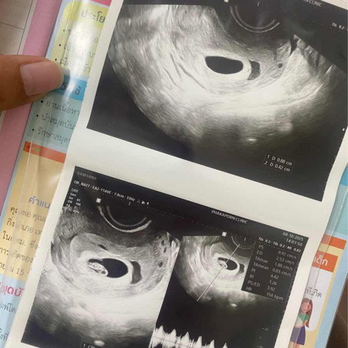 ครรภ์6วีค6วัน