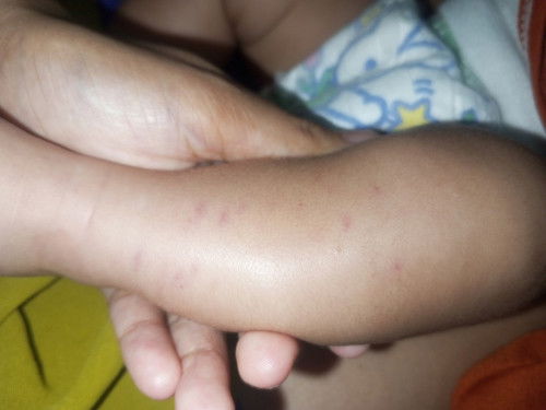 Bintik keunguan pada kaki bayi