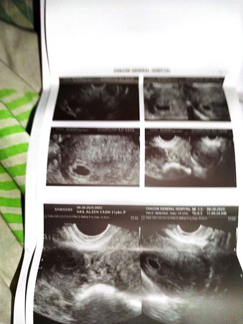 No heartbeat 6 weeks and 1day transvaginal ultrasound pero lmp ko sa clinic 7 weeks and 5 days