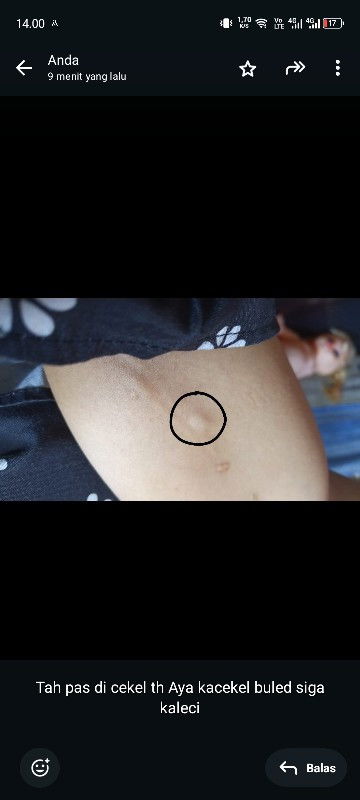 Benjolan pada implan