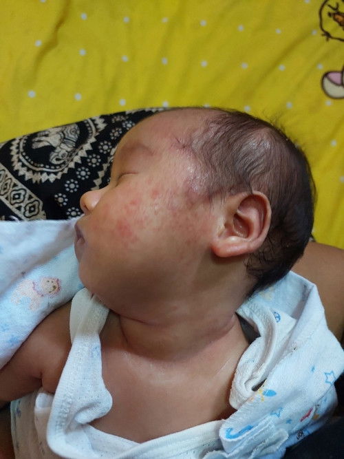 ผื่นที่หน้าทารก