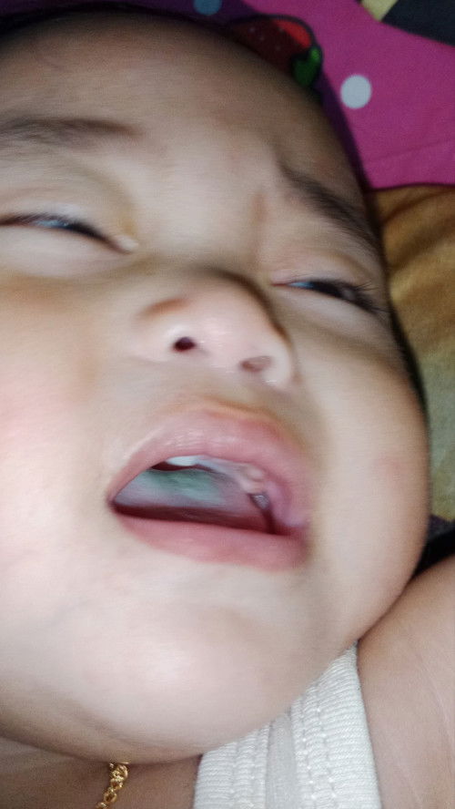 Lidah bayi berwarna biru
