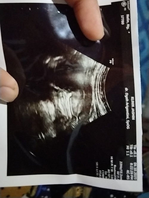 Ada yang bisa bacain hasil USG ini gak bun,