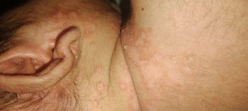 Bun bayi nya ada yg ngalamin kulitnya kya gni ga, trs ilang nya pakai apa