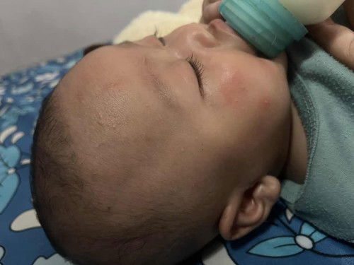 Rekomendasi salep gatel bayi