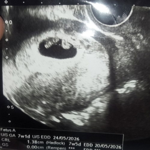 ซาวท้องครั้งแรก7w5d