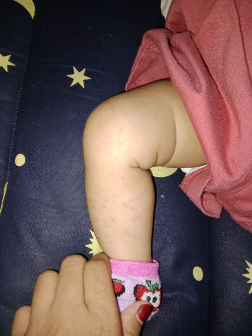 Kenapa  ya dikaki anak ku muncul bintik bintik merah